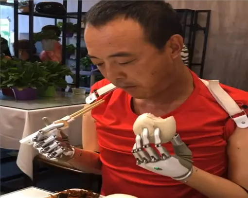 OHand双臂高位截肢安装适配案例 系列